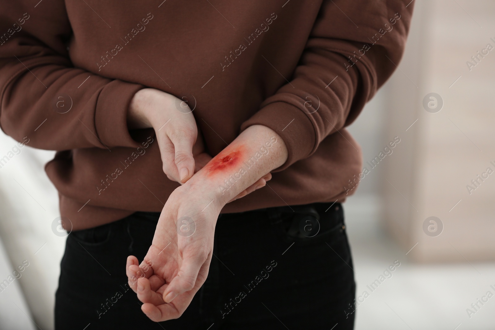 Photo of Woman with burn on her forearm indoors, closeup