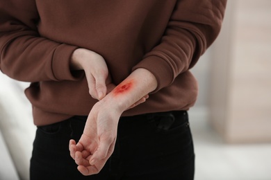 Photo of Woman with burn on her forearm indoors, closeup