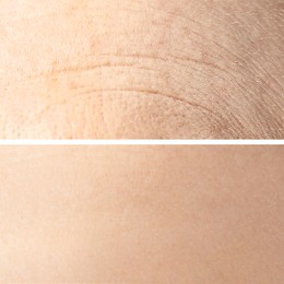 Image of Collage with photos of dry and moisturized skin texture