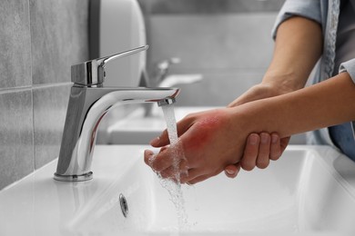 Photo of Woman holding burned hand under cold water indoors, closeup