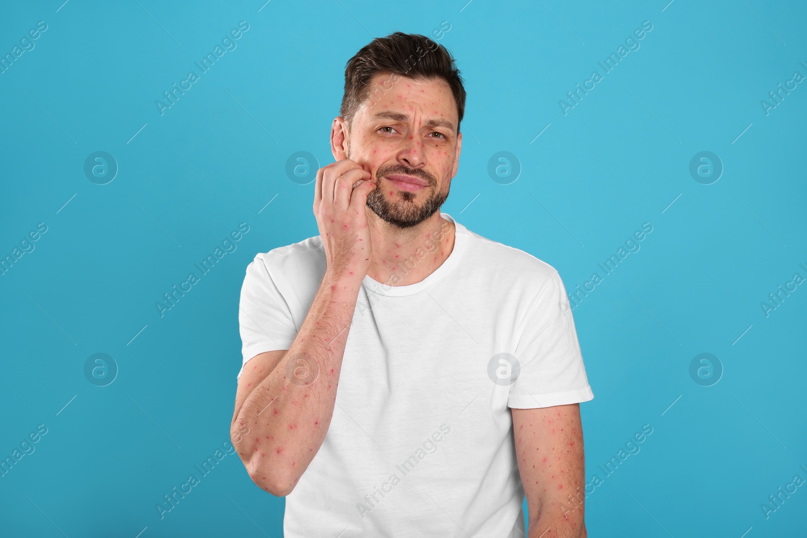 Photo of Man with rash suffering from monkeypox virus on light blue background