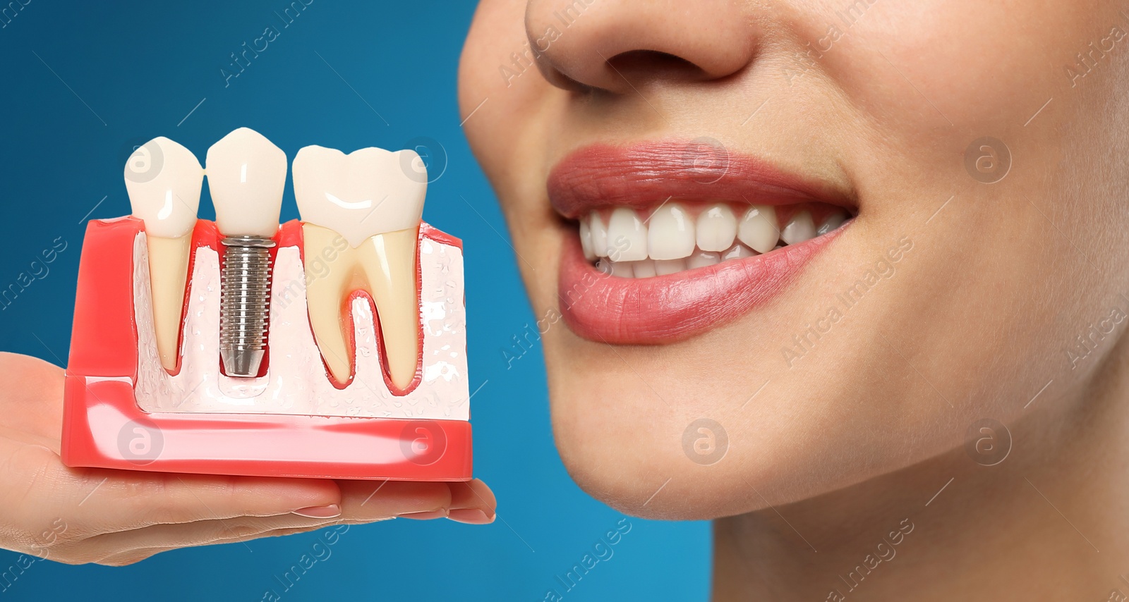 Image of Young woman with beautiful smile and dentist holding educational model of dental implant on blue background, closeup