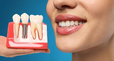 Image of Young woman with beautiful smile and dentist holding educational model of dental implant on blue background, closeup