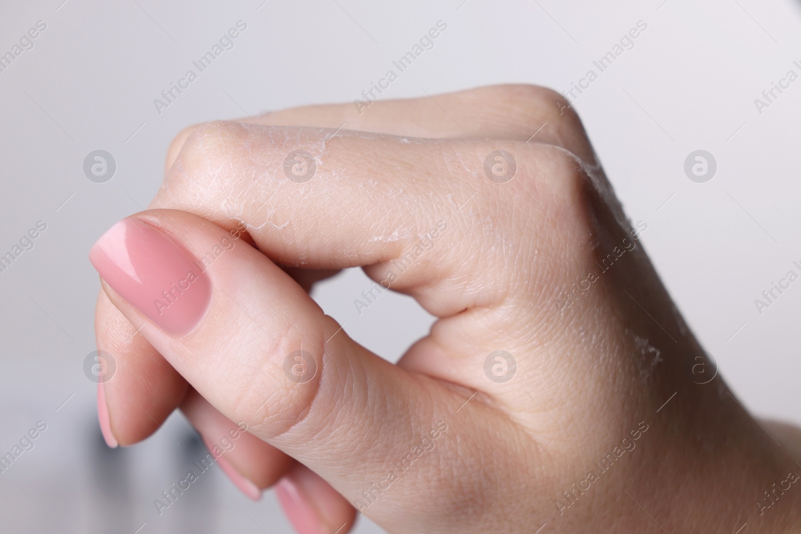 Photo of Woman with dry skin on hand against light background, macro view