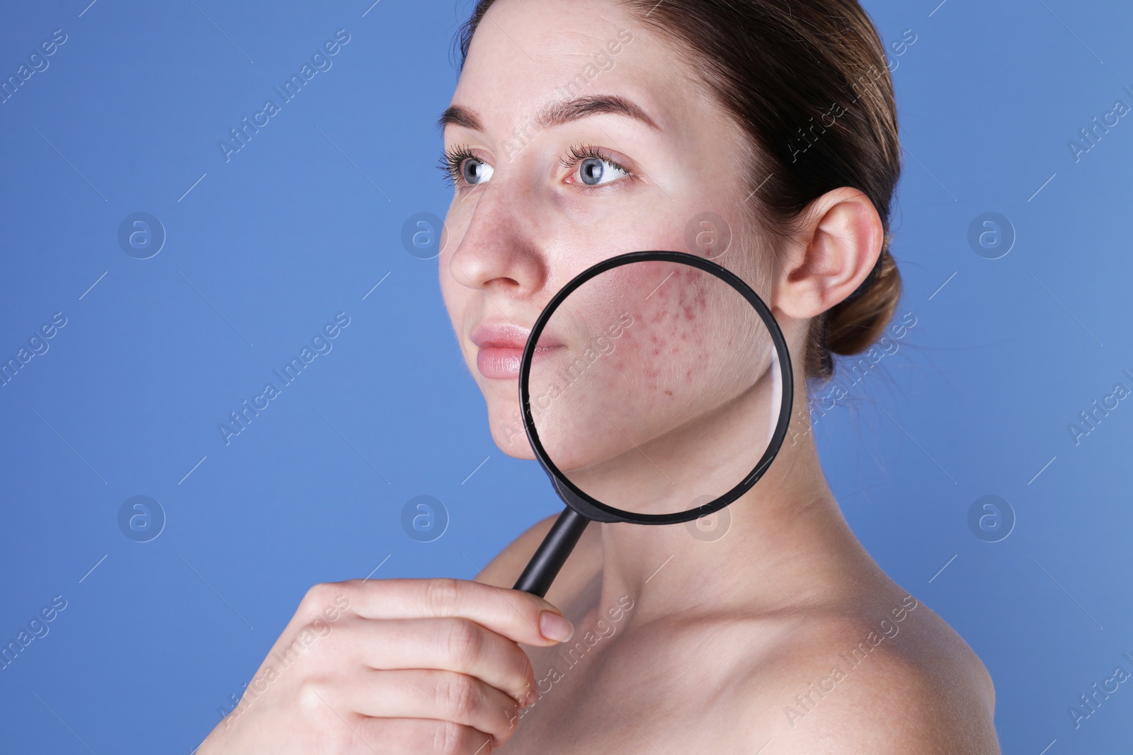 Photo of Young woman with acne problem holding magnifying glass near her skin on blue background