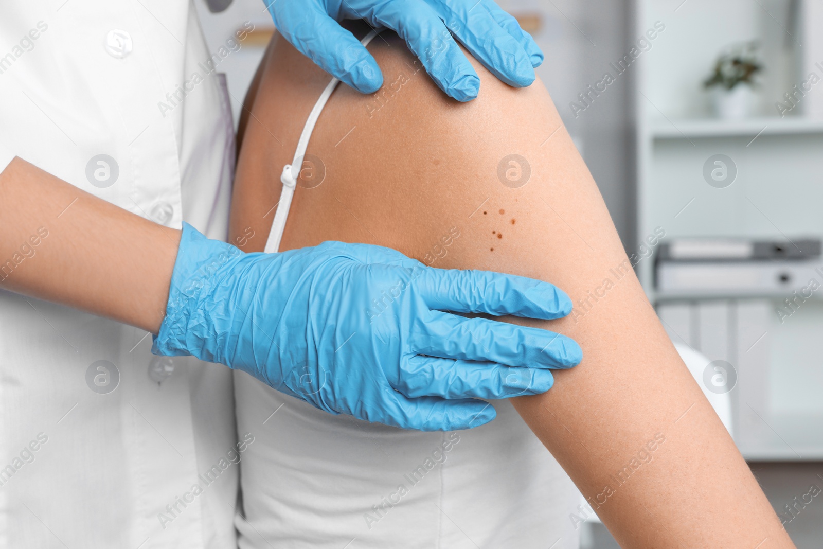 Photo of Dermatologist examining patient's birthmark in clinic, closeup