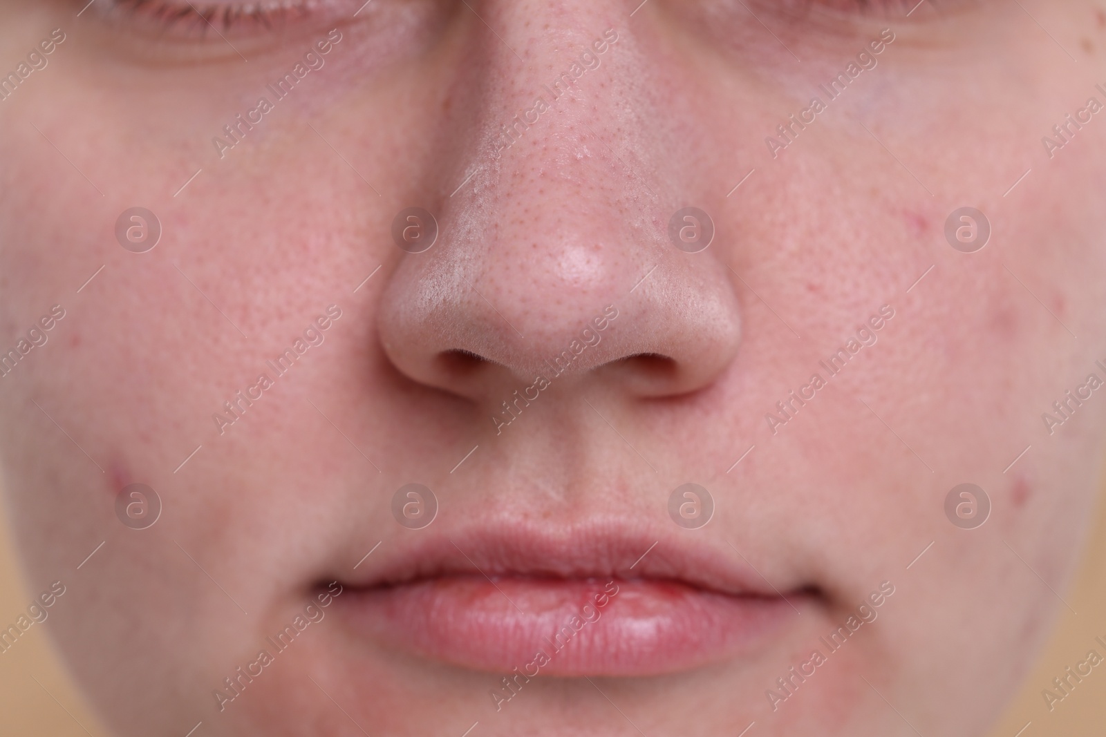 Photo of Closeup view of woman with blackheads on her nose