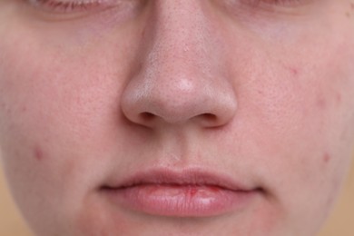 Photo of Closeup view of woman with blackheads on her nose