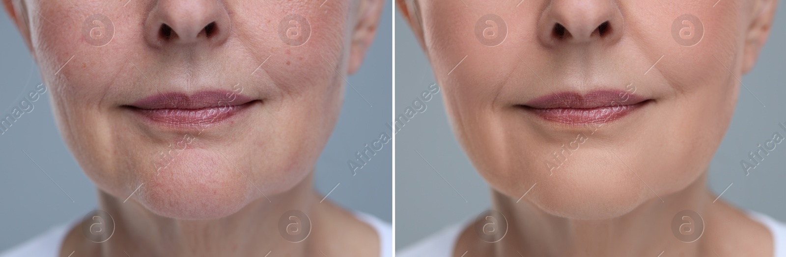 Image of Aging skin changes. Collage with photos of mature woman before and after cosmetic procedure on grey background, closeup