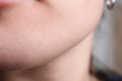 Photo of Woman with dry skin on face, closeup
