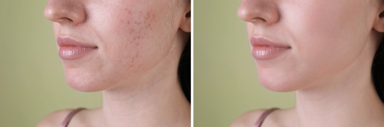 Image of Acne problem. Young woman before and after treatment on green background, closeup. Collage of photos