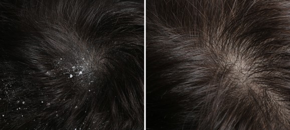 Man showing hair before and after dandruff treatment, collage