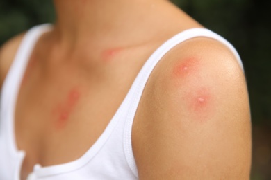 Photo of Woman with insect bites on body outdoors, closeup view
