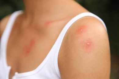 Woman with insect bites on body outdoors, closeup view