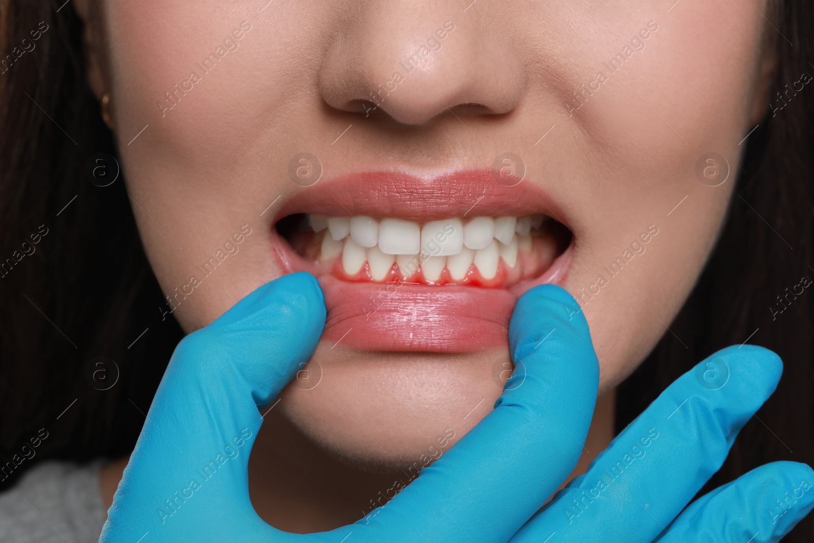 Image of Doctor examining woman's inflamed gum, closeup. Oral cavity health