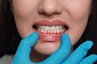 Image of Doctor examining woman's inflamed gum, closeup. Oral cavity health