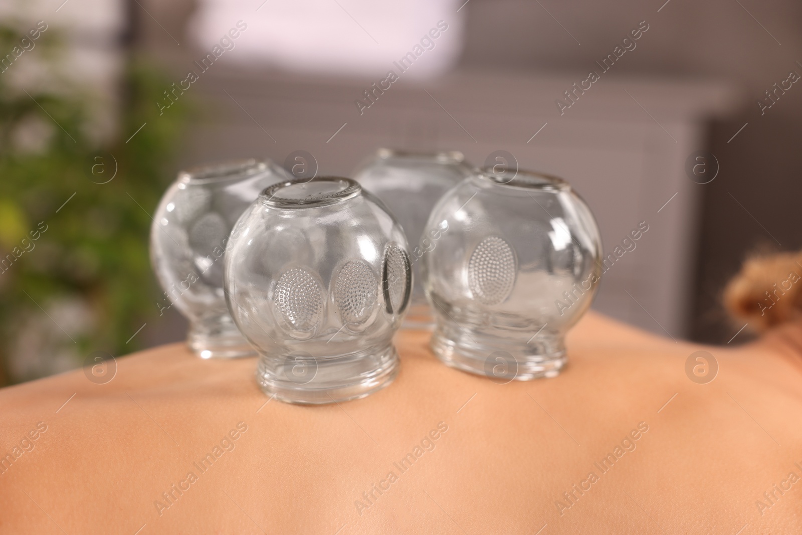 Photo of Cupping therapy. Closeup view of woman with glass cups on her back indoors