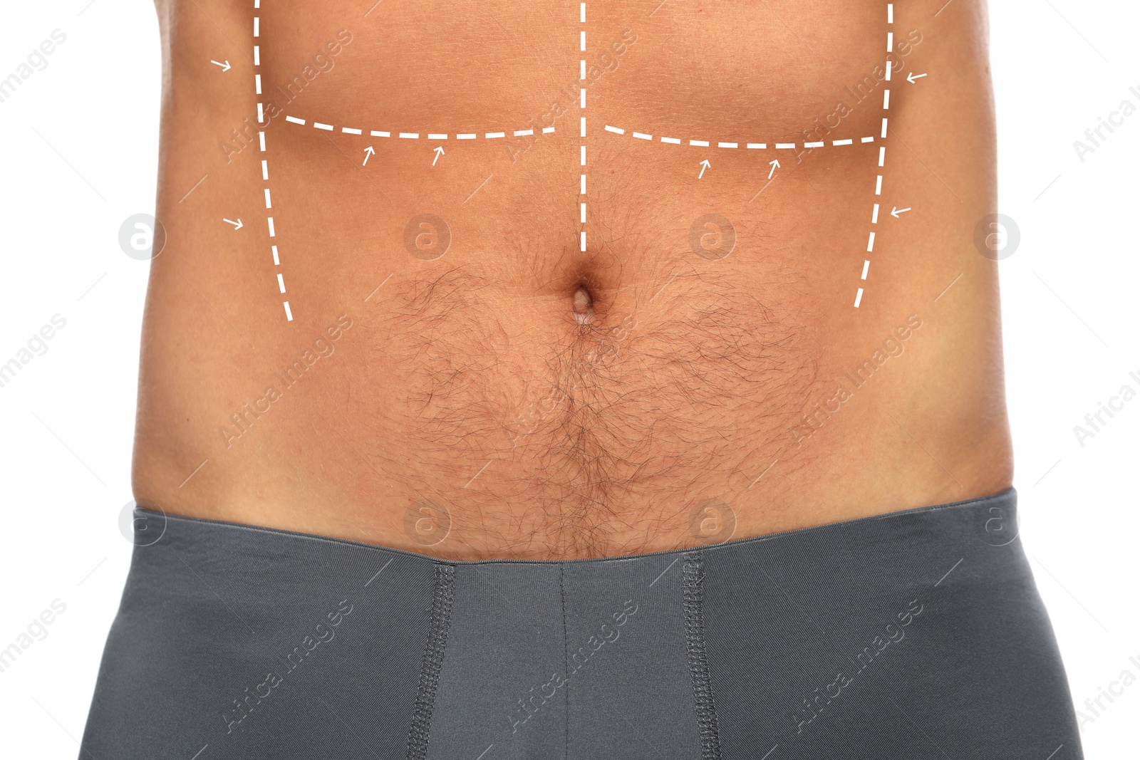 Image of Man with markings for cosmetic surgery on his abdomen against white background, closeup