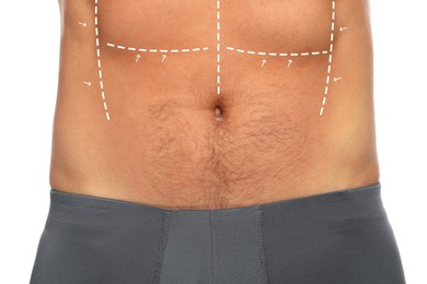 Man with markings for cosmetic surgery on his abdomen against white background, closeup