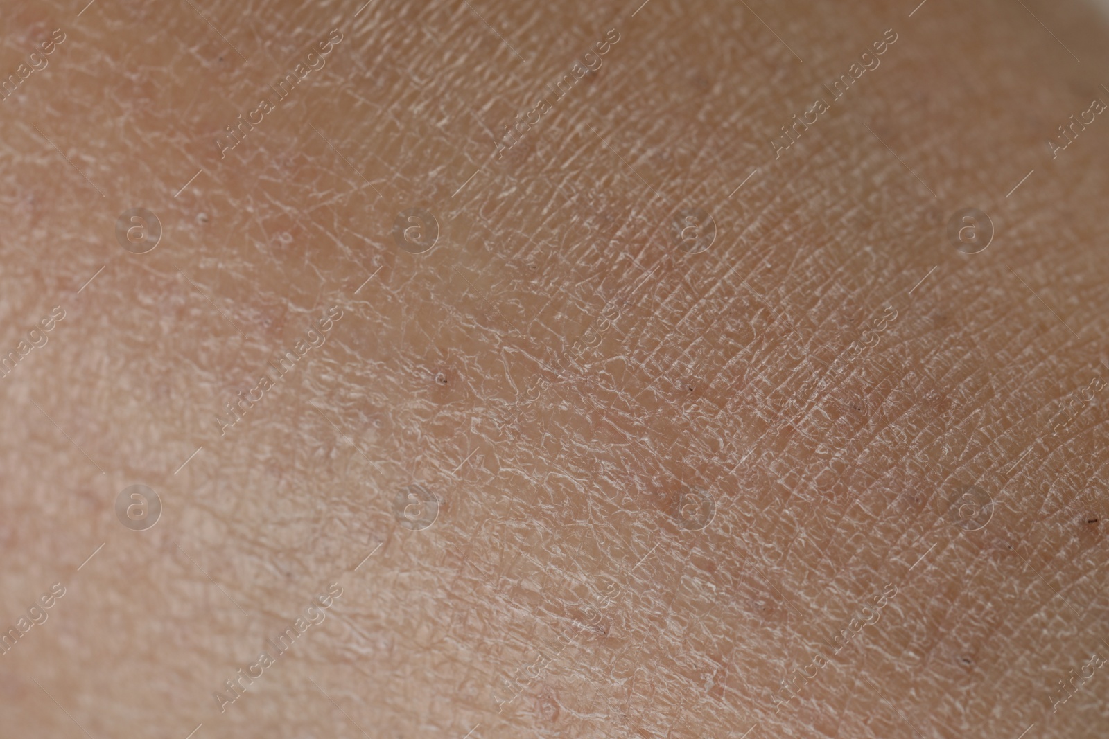 Photo of Closeup view of dry skin as background