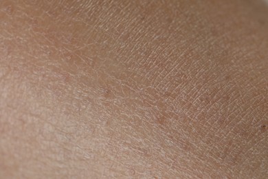 Photo of Closeup view of dry skin as background