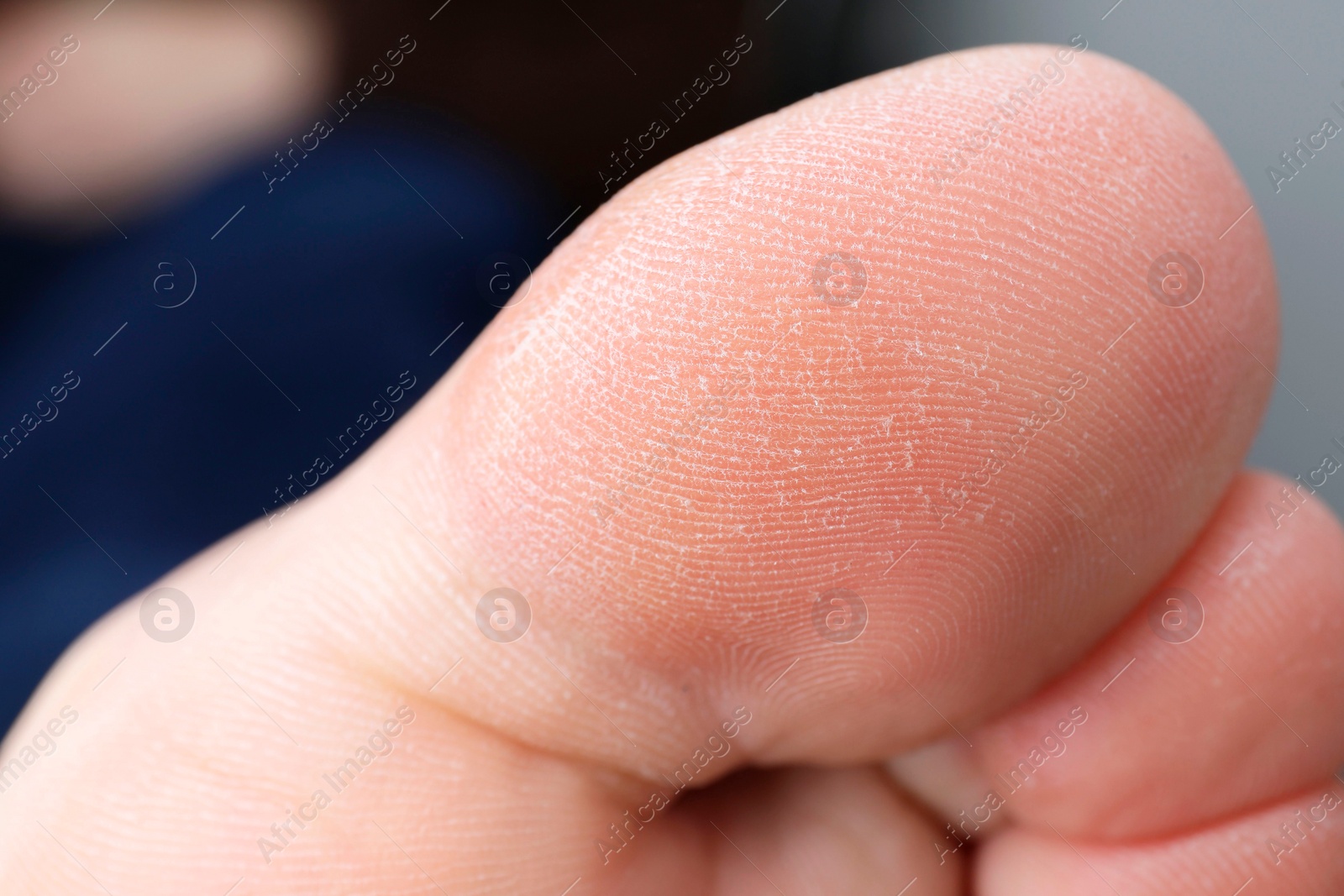 Photo of Woman with dry skin on toes against blurred background, closeup