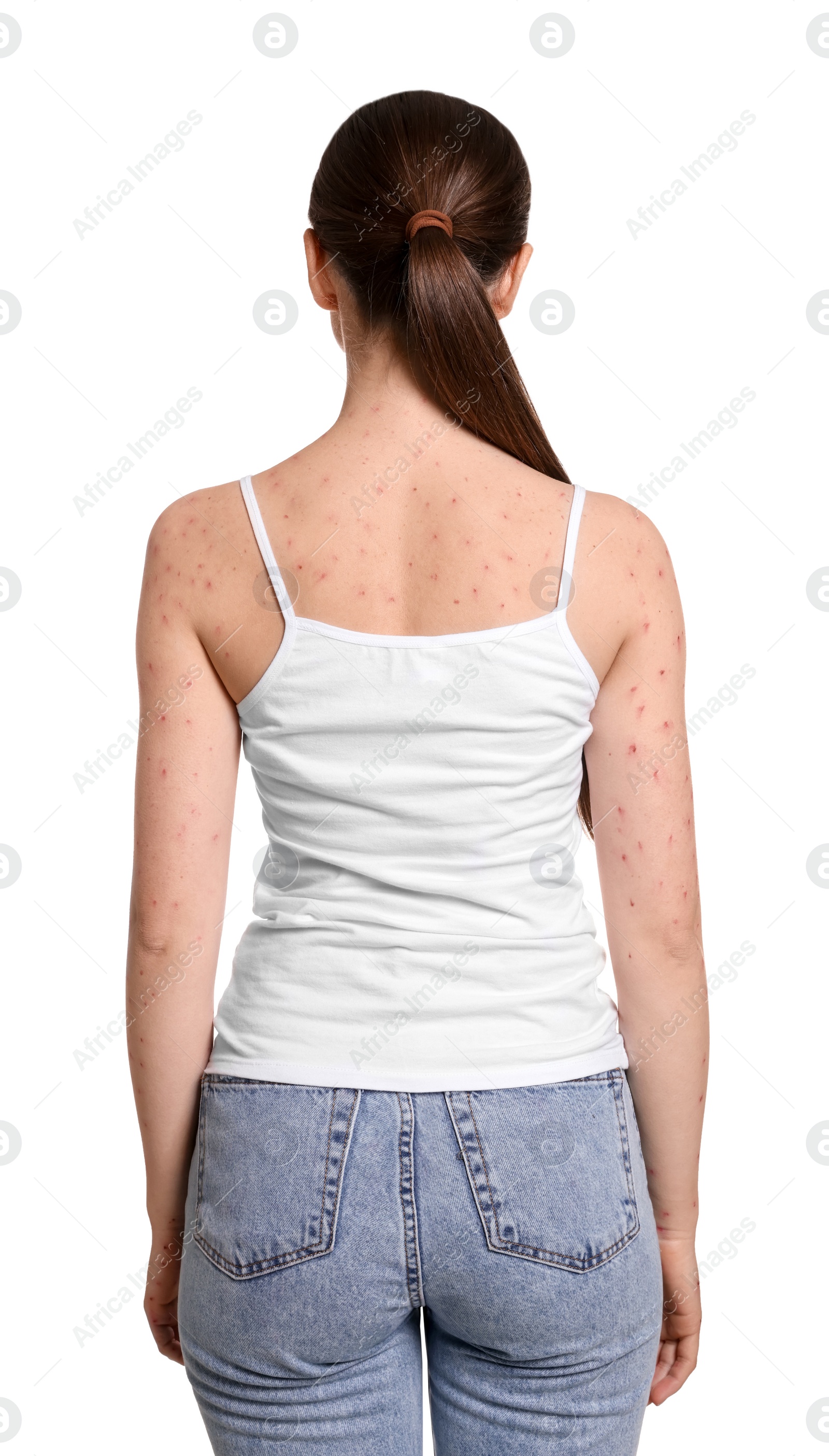 Photo of Woman with rash suffering from monkeypox virus on white background, back view