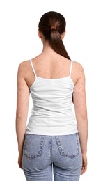 Photo of Woman with rash suffering from monkeypox virus on white background, back view