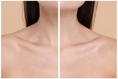 Aging skin changes. Woman showing neck before and after rejuvenation, closeup. Collage comparing skin condition