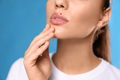 Image of Woman with herpes on lips against light blue background, closeup