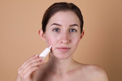 Young woman with acne problem applying cosmetic product onto her skin on beige background