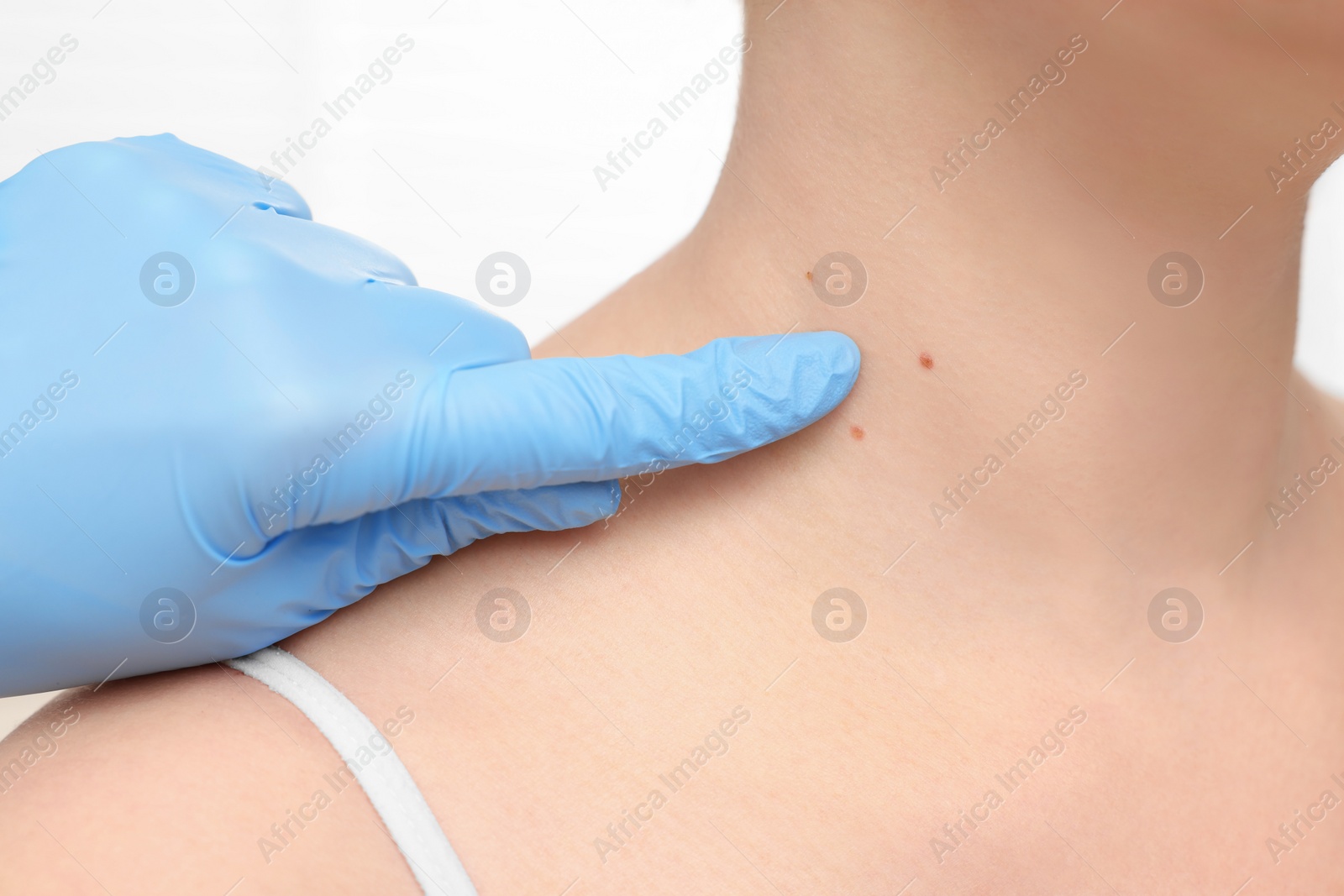 Photo of Dermatologist in rubber glove examining patient's birthmark on blurred background, closeup