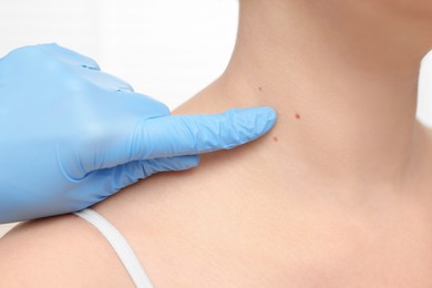 Dermatologist in rubber glove examining patient's birthmark on blurred background, closeup