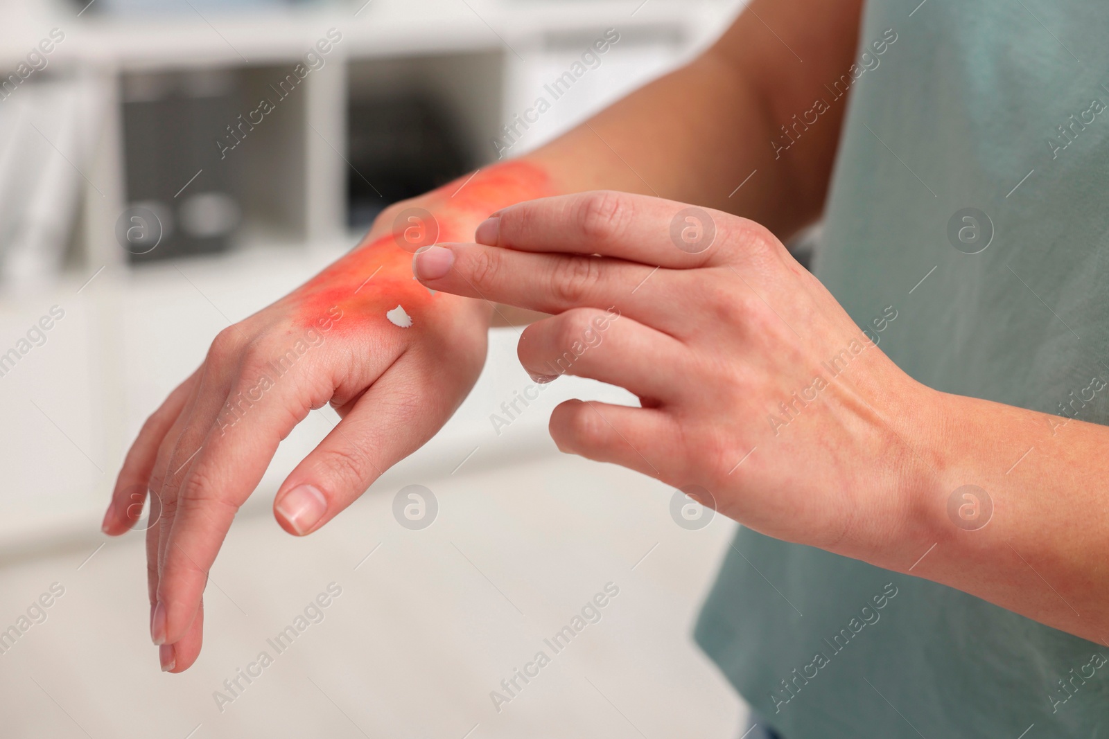 Photo of Woman applying healing cream onto burned hand indoors, closeup