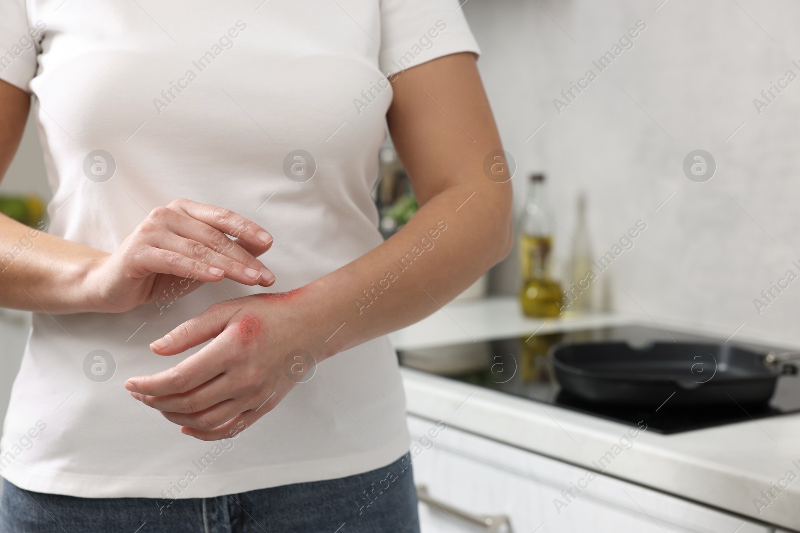 Photo of Woman with burns on her hand in kitchen, closeup. Space for text