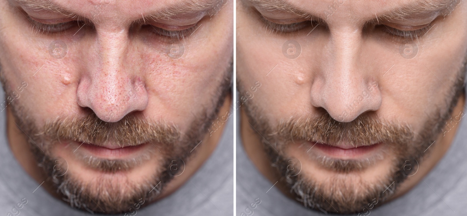 Image of Blackhead treatment, before and after. Collage with photos of man, closeup view