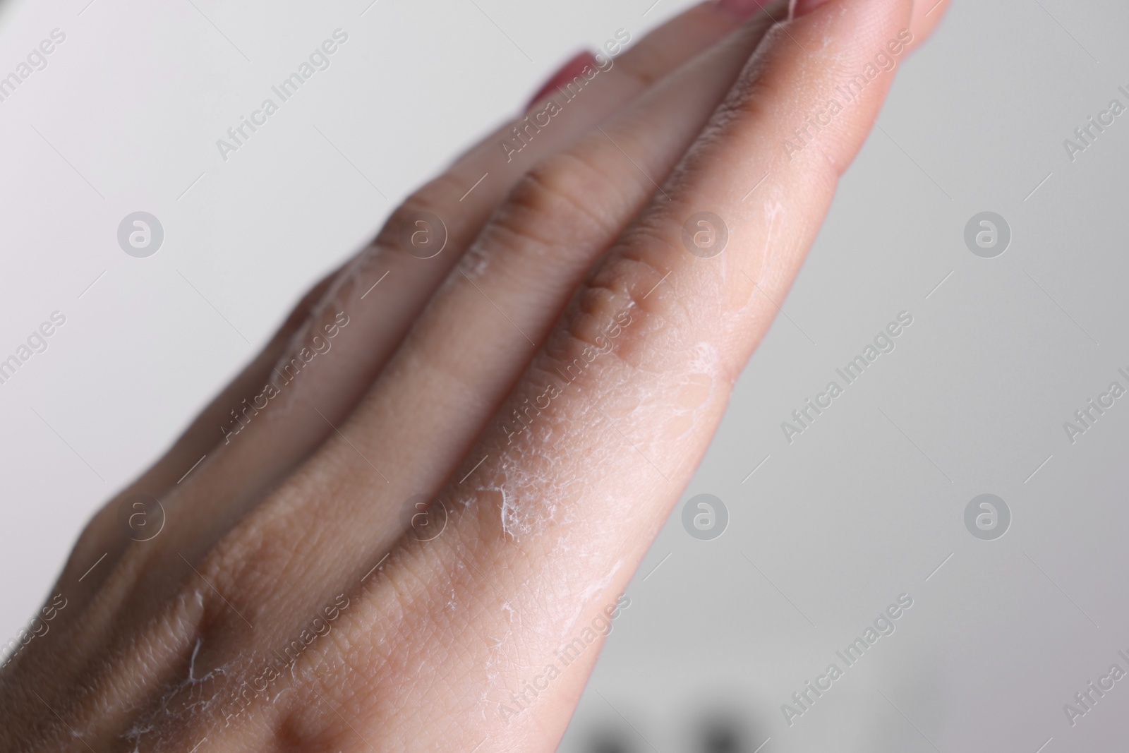 Photo of Woman with dry skin on hand against light background, macro view