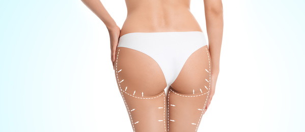 Image of Slim young woman with marks on body for cosmetic surgery operation against light background, closeup. Banner design