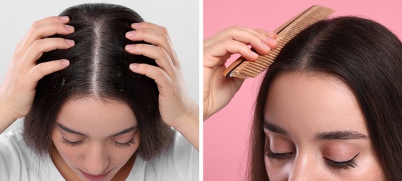 Image of Woman showing hair before and after dandruff treatment on color backgrounds, collage