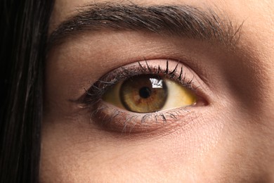 Photo of Woman with yellow eyes as background, closeup. Liver problems symptom