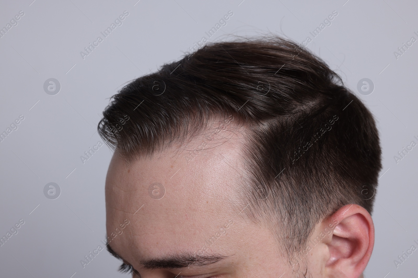 Photo of Baldness concept. Man with receding hairline on light grey background, closeup