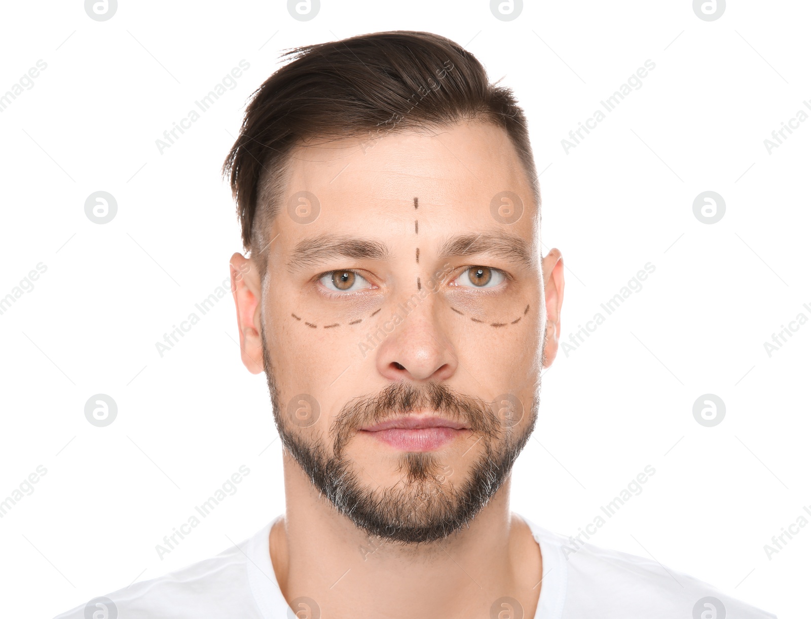 Photo of Portrait of mature man with marks on face preparing for cosmetic surgery against white background
