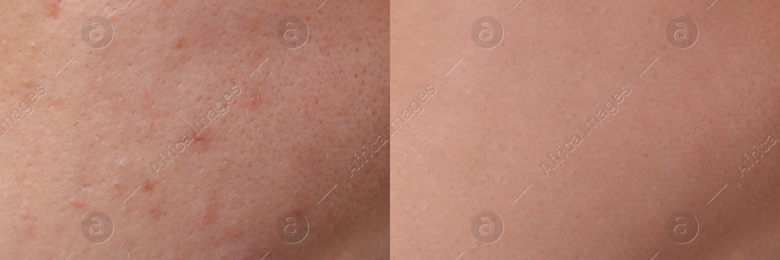 Image of Collage with photos of person suffering from acne before and after treatment, closeup. Banner design showing affected and healthy skin