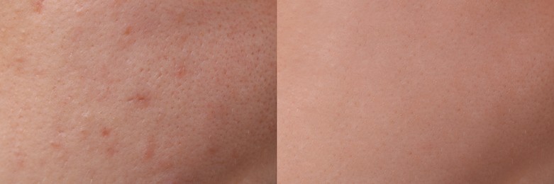 Image of Collage with photos of person suffering from acne before and after treatment, closeup. Banner design showing affected and healthy skin