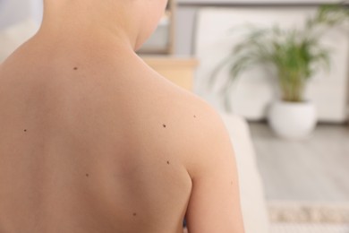 Photo of Closeup of boy's body with birthmarks in living room, back view. Space for text