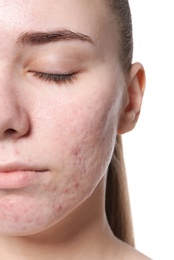 Young woman with acne problem on white background