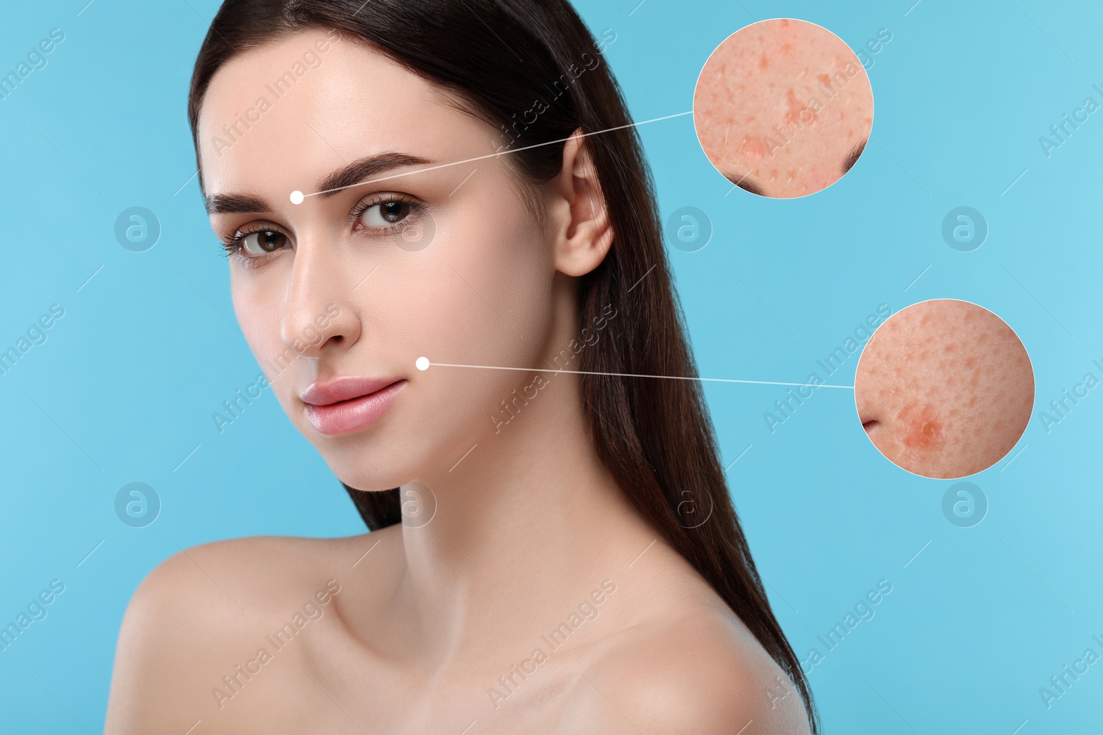 Image of Dermatology. Woman with skin problem on light blue background. Zoomed areas showing acne