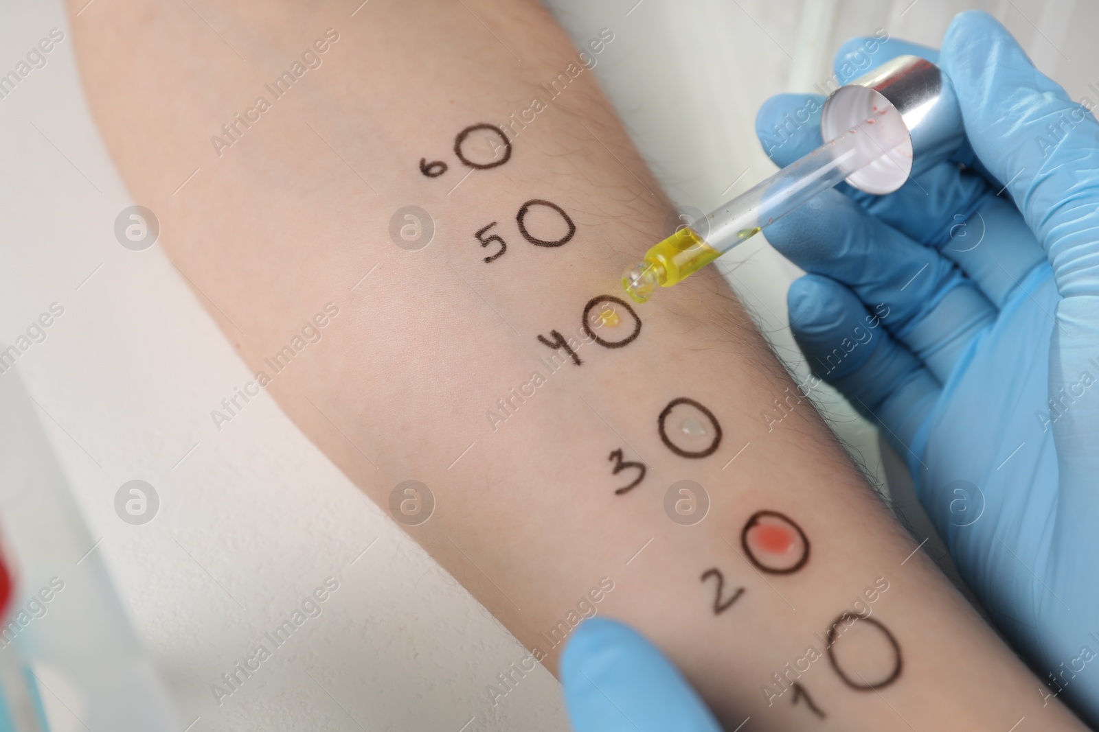 Photo of Doctor doing skin allergy test at light table, closeup