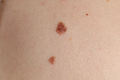 Photo of Closeup view of woman's body with birthmarks as background