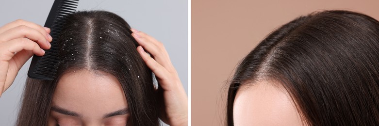 Image of Woman showing hair before and after dandruff treatment on color backgrounds, collage